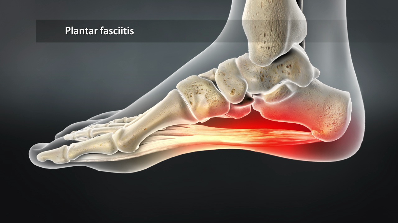 Graphic of a foot showing Plantar Fasciitis pain point